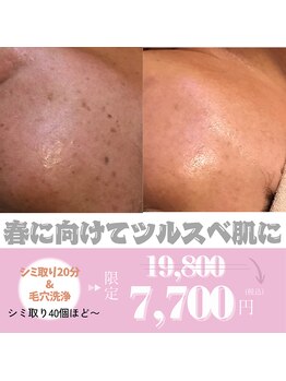 プリトリート(Pritreat)の写真/【春モニターキャンペーン】シミケアし放題20分＆毛穴洗浄7,700円！気になる肌悩みにフェイシャルケア