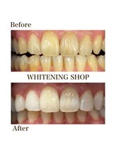 ホワイトニングショップ 徳島藍住店/Before After美白ホワイトニング