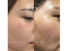 ハーバリー ハーブピーリング 岐阜(HERBERRYハーブピーリング)/ハーブピーリング専門店HERBERRY