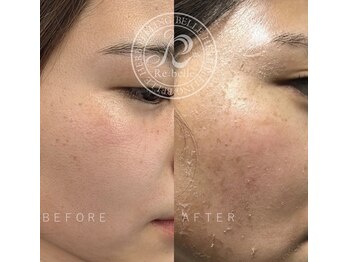 ハーバリー ハーブピーリング 岐阜(HERBERRYハーブピーリング)/ハーブピーリング専門店HERBERRY