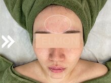 グリーンピール エルモナ(GREENPEEL ELMONA)/【グリーンピール５Days】