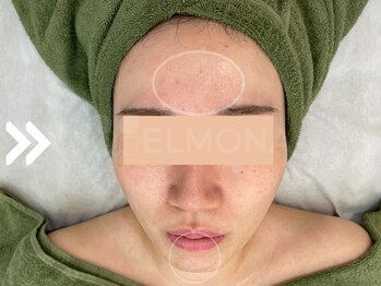 グリーンピール エルモナ(GREENPEEL ELMONA)/【グリーンピール5Days】