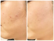 ラウン 京都(ROUN')/4回の施術ビフォーアフター