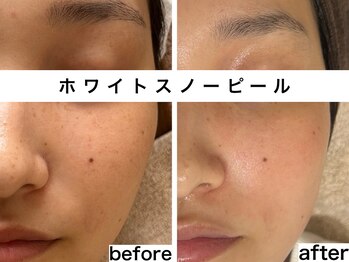 ラヴァンド(Lavande)/【ホワイトスノーピール】 症例