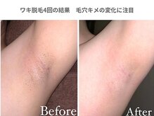 ピュアノア 垂水店/ワキ脱毛 全身脱毛 神戸垂水明石