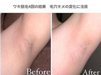 ピュアノア 垂水店/ワキ脱毛 全身脱毛 神戸垂水明石