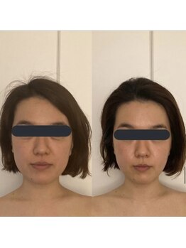 ハイコガオ 中崎町店(HIKOGAO)/小顔矯正