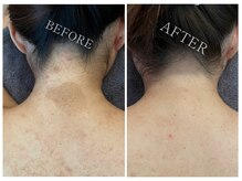 ホウビ(HOUBIE)の雰囲気(《アザ》医療でも改善が難しい幼少期からある茶アザ改善ケア)