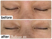 アール(R)/【タラソトリートメント】