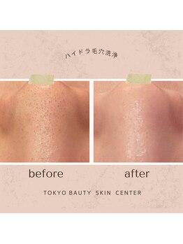 東京ビューティースキンセンター 五反田/ハイドラウォーターピーリング