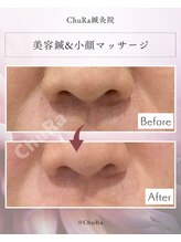 チュラ鍼灸院 西宮北口(ChuRa鍼灸院)/美容鍼&小顔マッサージ