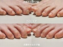 ニコプラス(NICO+)/フット爪育ネイルケア