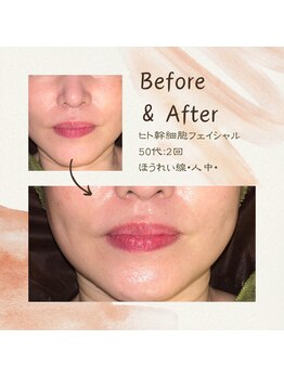 アンフィニ 麻布十番(Infini)/ヒト幹細胞フェイシャル