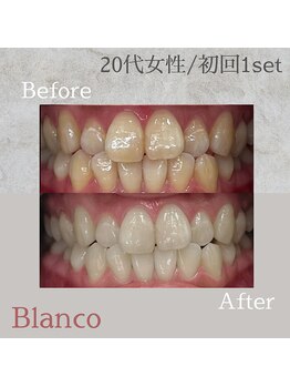 ブランコ 川口店(Blanco)/セルフホワイトニング♪症例写真