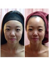 ナロウ(Narow)/モテ肌・小顔＆ハーブピーリング