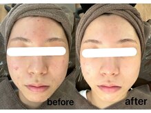 ジャスミンビューティー(Jasmine Beauty)/肌荒れ、ニキビケアもお任せ