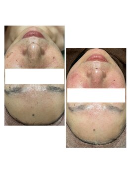 カヌヌ(Kanunu)/プラズマシャワーとシミケア