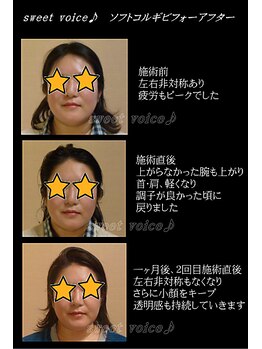 スイートボイス(sweet voice)/小顔矯正ビフォーアフター