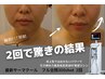 【全顔フル300shot】結果◎しっかりサーマクール☆強力肌引き締め・リフトUP