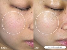 フォンビューティー(fon beauty)/赤み×乾燥ケア1回