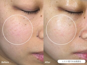 フォンビューティー(fon beauty)/赤み×乾燥ケア1回