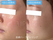アクネラボ 梅田店(ACNE LABO)/毛穴・赤ら顔も