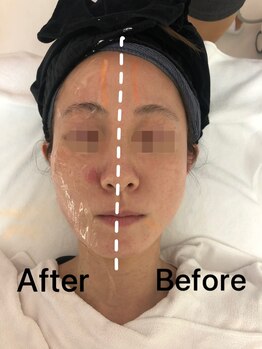 ナラビューティー(NARA BEAUTY)/輪郭リフト一回の効果小顔恵比寿