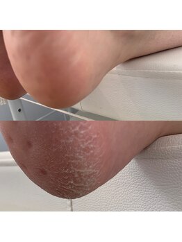 リッチオ(Riccio)/角質除去