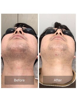 マリーローラン メンズルイズ(Marryrolan MensRuise)/メンズ脱毛【ヒゲ脱毛】