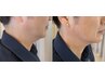 【小顔/レモンボトル】ダウンタイムなしで持続性のある小顔効果