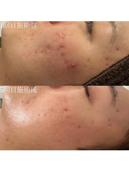 リメレ(Rimere)/ニキビケア・肌質改善