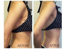 レナトゥス 銀座(Renatus)/二の腕3回結果【痩身/銀座】