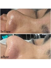 ジョルフ サロン オリジナル(JOLF salon original)/毛穴の詰まり、黒ずみ除去