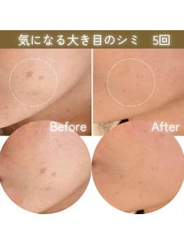 ココロ(COCORO)/◎◎を剥がすシミケア