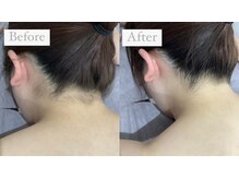 ビオラス 光吉店(VIOLUS)/うなじ脱毛