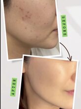 ダブリュービー(WB)/ハードハーブピーリング10回目