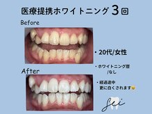 セイ(sei)/ホワイトニング途中経過