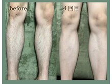 AG/【男性】足まるごと脱毛