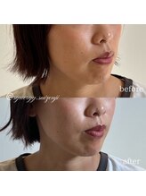 シナジープラス 水前寺店(SYNERGY+)/《初回お試し》トライアル美容鍼