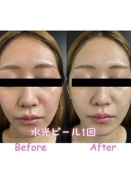 エーエスビューティーサロン(AS Beautysalon)/エクスビアンス　before/after