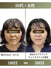 けいのき鍼灸整骨院/美容鍼1ヵ月5回の効果！美容鍼灸