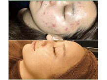 エム(M)/ハーブピーリング