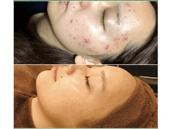 エム(M)/ハーブピーリング