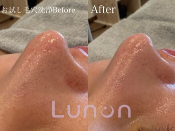 ルノン(Lunon)/お試し毛穴洗浄ハイドロ
