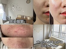 フェリス(feliz)の雰囲気（癒されながら素肌美人に♪ララピール/ハーブピーリング/プラズマ）