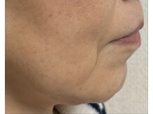 シーフェイス(see face)/フェースラインのたるみ改善