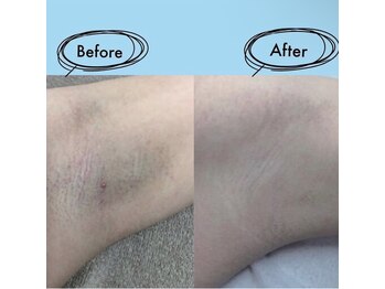 アイビークイーン(I.B.QUEEN)/黒いボツボツにサヨウナラ