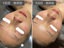 ロッタ エクリュ(Lotta ecru+)/REVI剥けないハーブピーリング