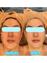 クラッシーガール ダンディエール(QlassyGirl DANDYELL)/【20代】5回後/脂肪燃焼マシン