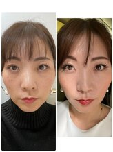 リローゼ(Re.ROSE)/目のクマ、毛穴が小さく